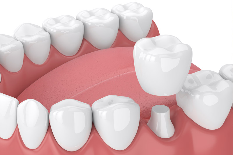 Dental Crowns in Lawrenceville