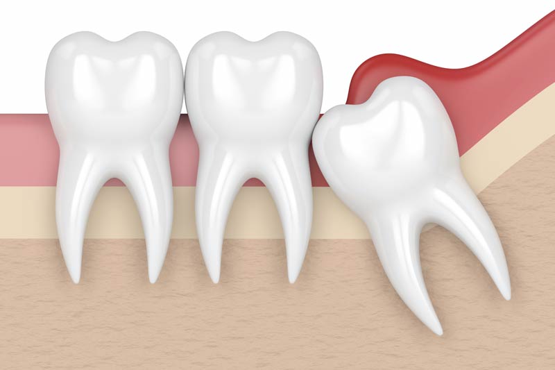 Wisdom Tooth Removal in Lawrenceville