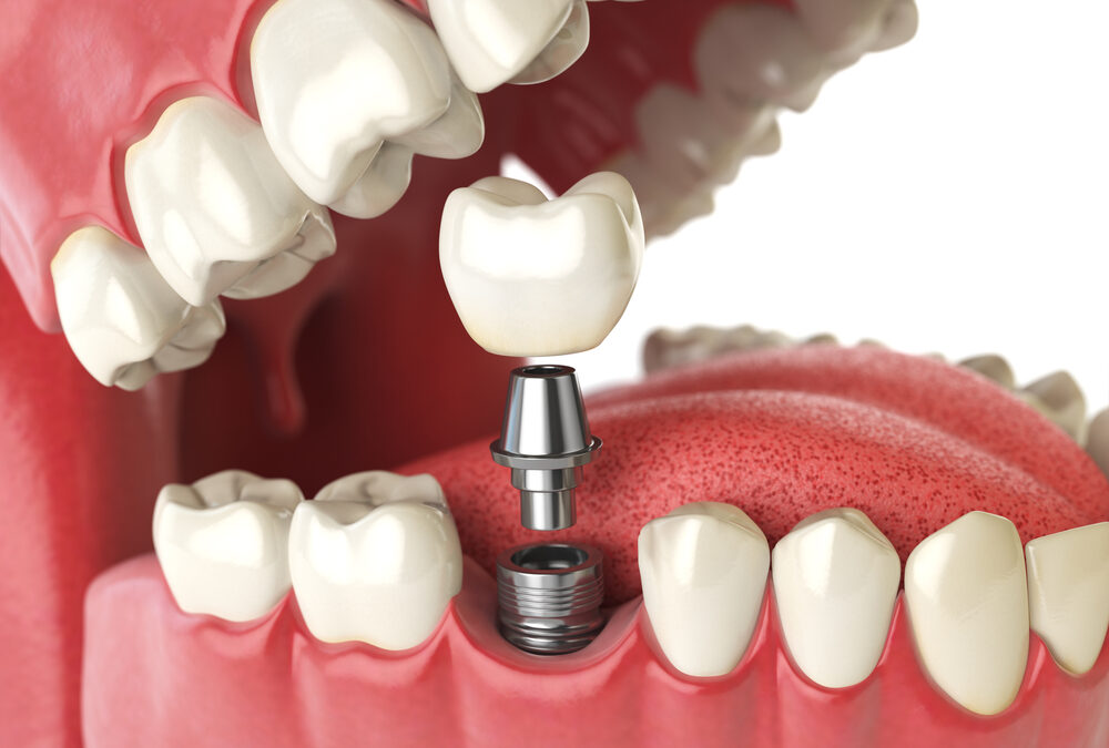 Do I Need Dental Implants? Lawrenceville